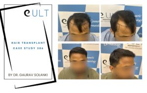 Hair Transplant case 386