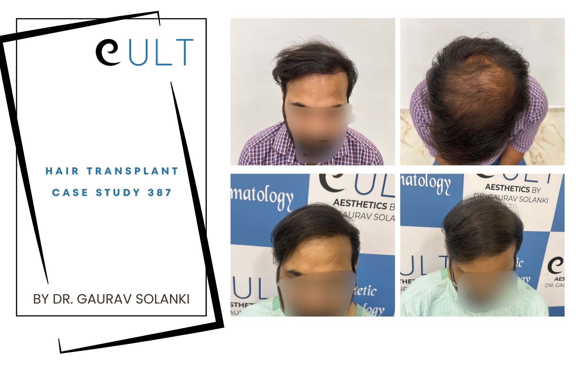 Hair Transplant case 387