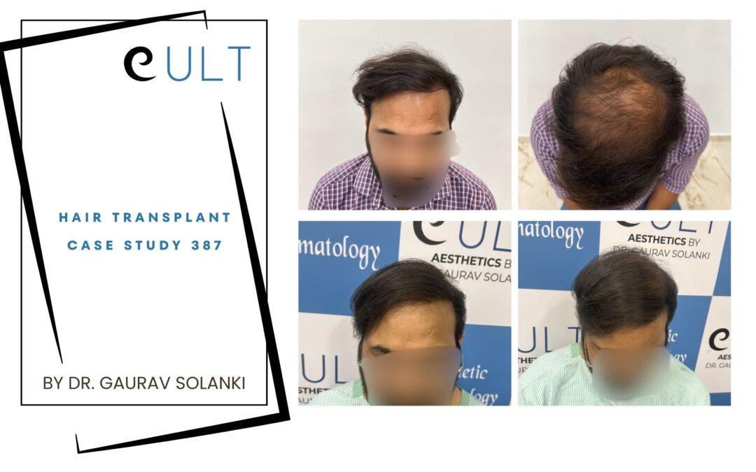 Hair Transplant Case 387