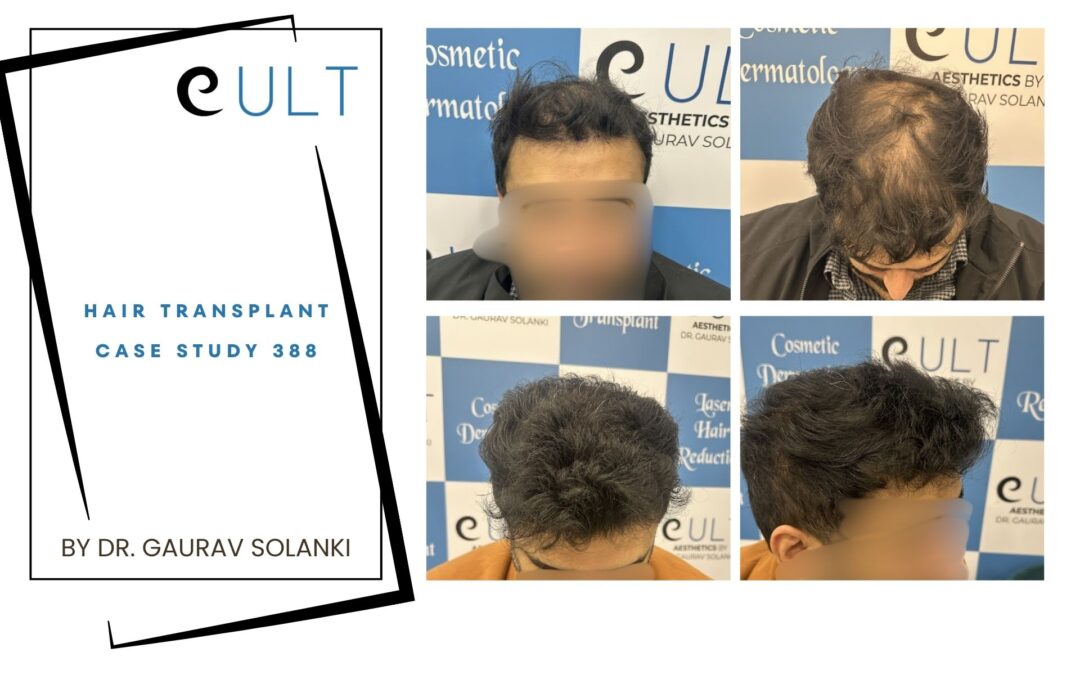 Hair Transplant Case 388