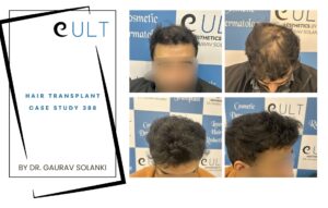 Hair Transplant case 388
