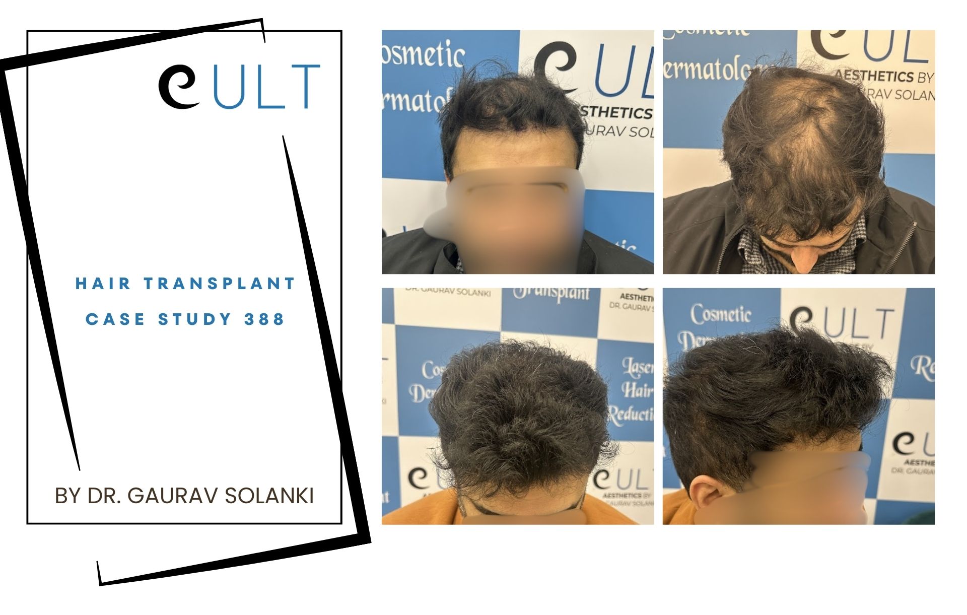 Hair Transplant case 388
