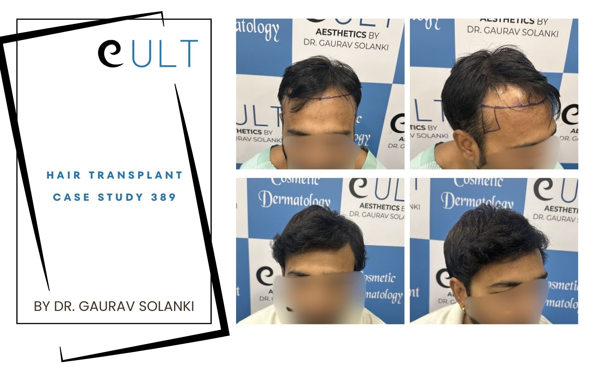 Hair Transplant case 389