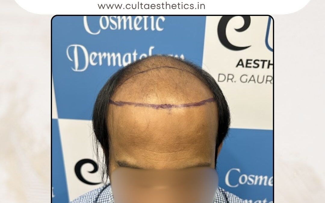 Hair Case 380 Before 1