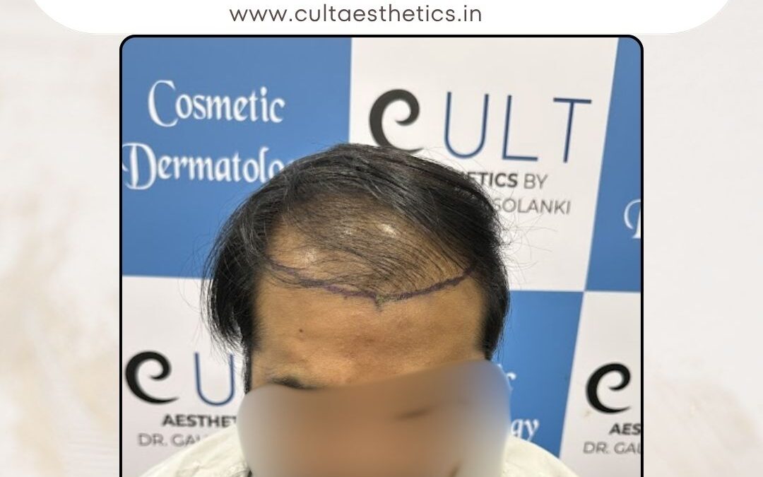 Hair Case 381 Before 1