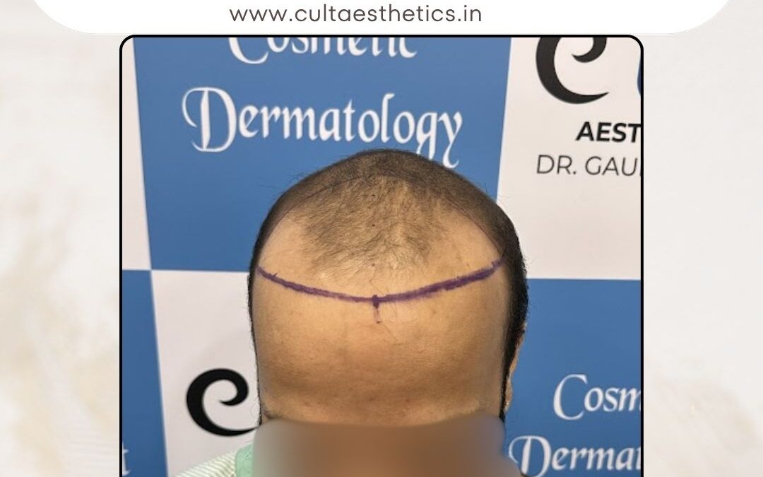 Hair Case 382 Before 1