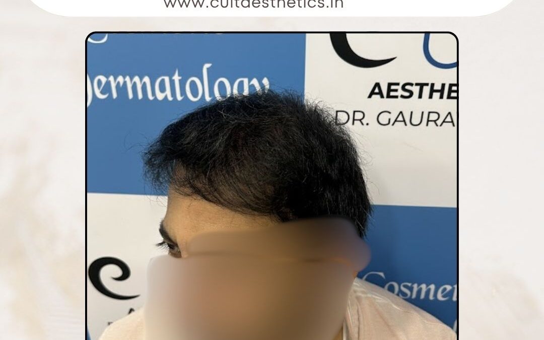 Hair Case 380 After 2