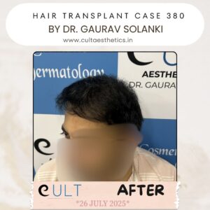 hair case 380 After-2