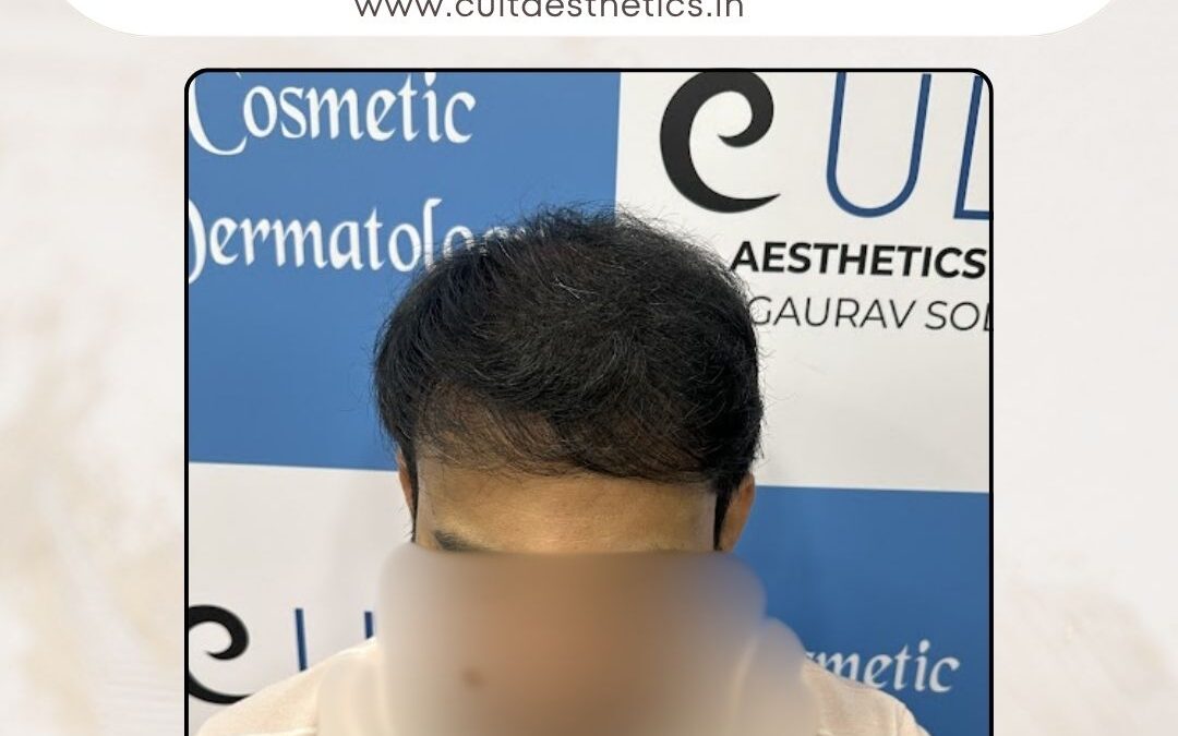 Hair Case 380 After 4