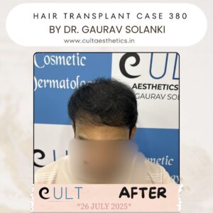 hair case 380 After-4