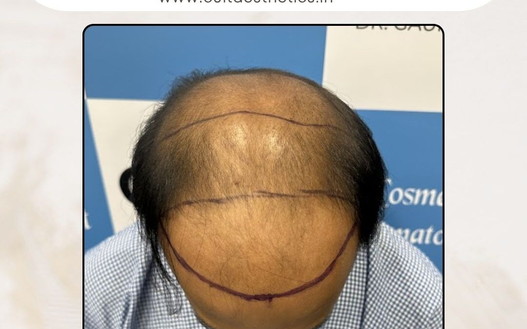 Hair Case 380 Before 2