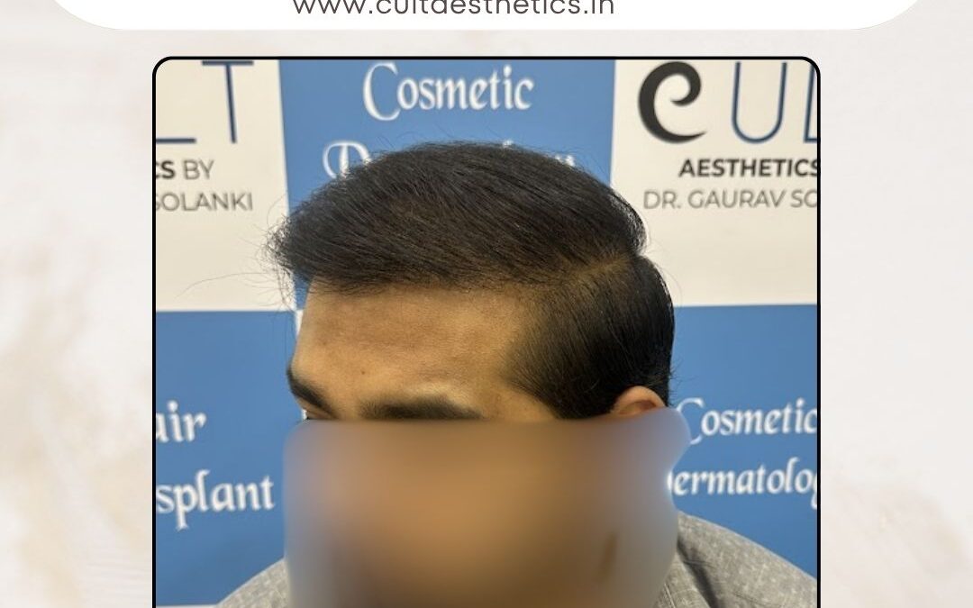 Hair Case 381 After 2