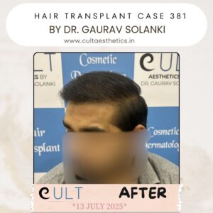 hair case 381 After-2