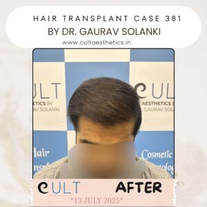 hair case 381 After-3