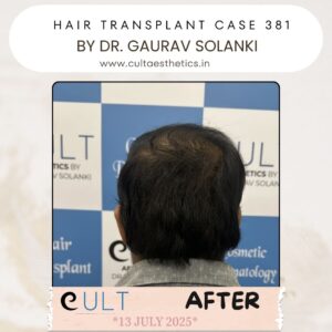 hair case 381 After-4