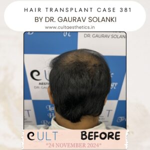 hair case 381 Before-4