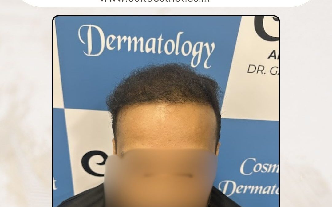 Hair Case 382 After 1