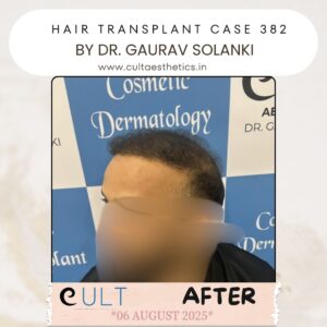 hair case 382 After-3