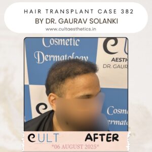 hair case 382 After-4