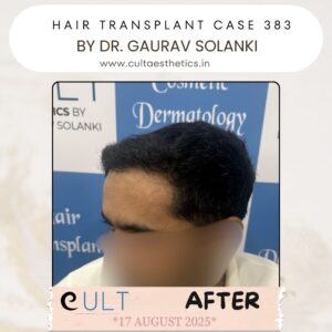 hair case 383 After-2