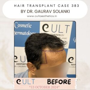 hair case 383 Before-3