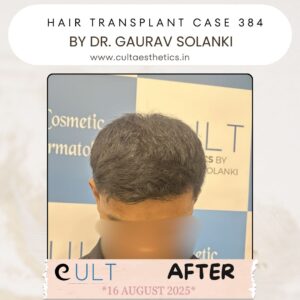 hair case 384 After-2