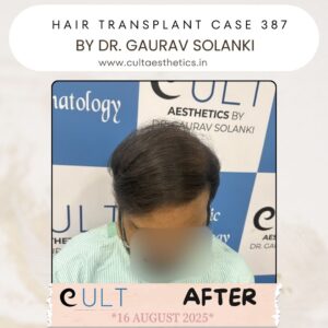 hair case 387 After-2