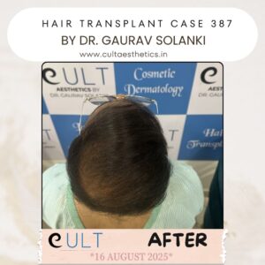 hair case 387 After-3