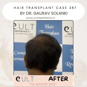 hair case 387 After-4