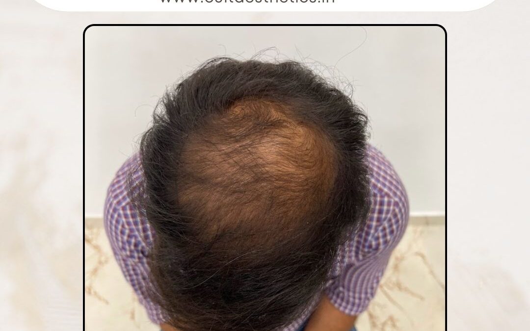 Hair Case 387 Before 2