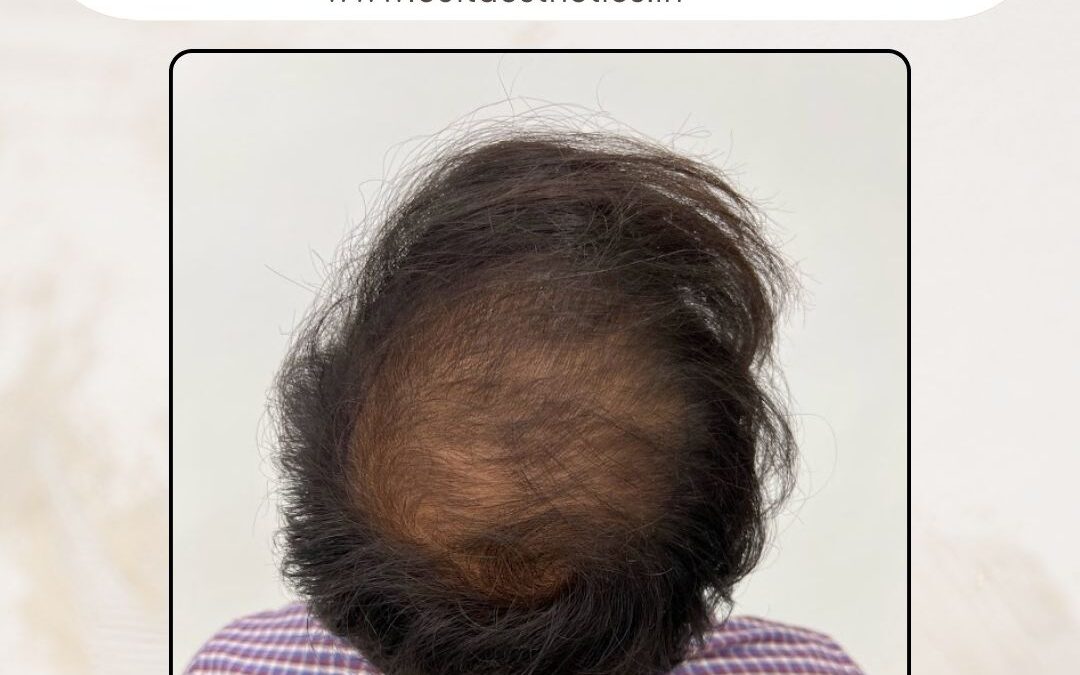 Hair Case 387 Before 3