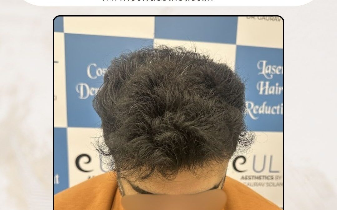 Hair Case 388 After 1