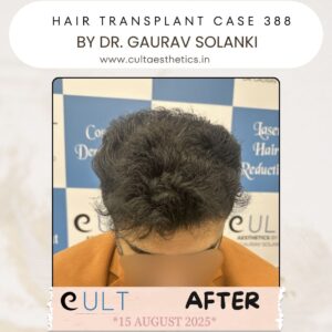 hair case 388 After-1
