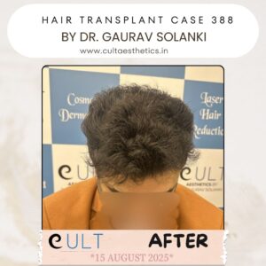 hair case 388 After-2