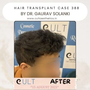 hair case 388 After-3