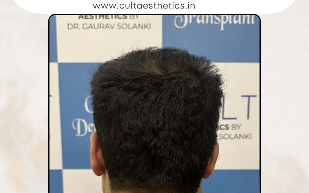 Hair Case 388 After 4