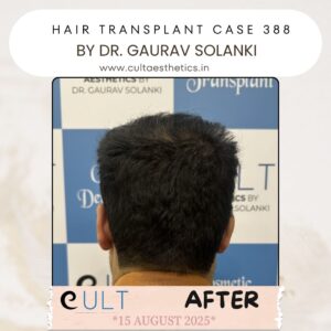 hair case 388 After-4