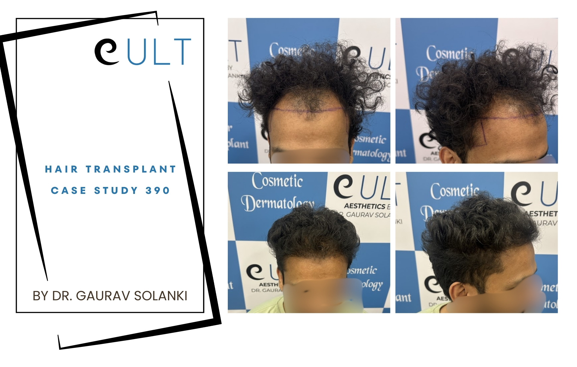 Hair Transplant case 390