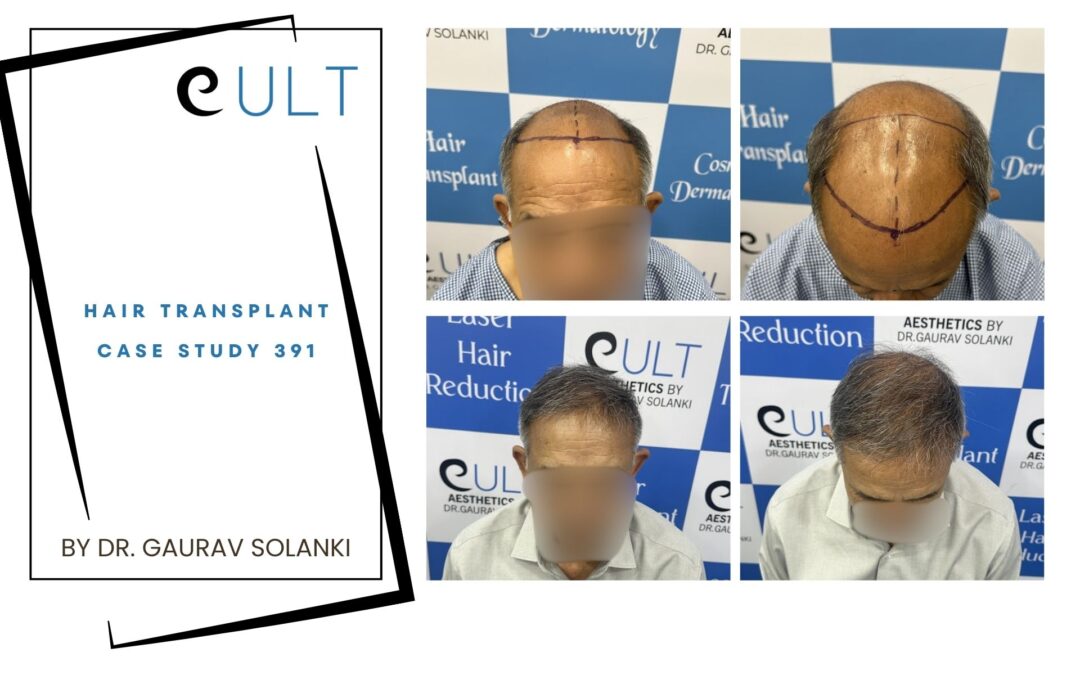 Hair Transplant Case 391