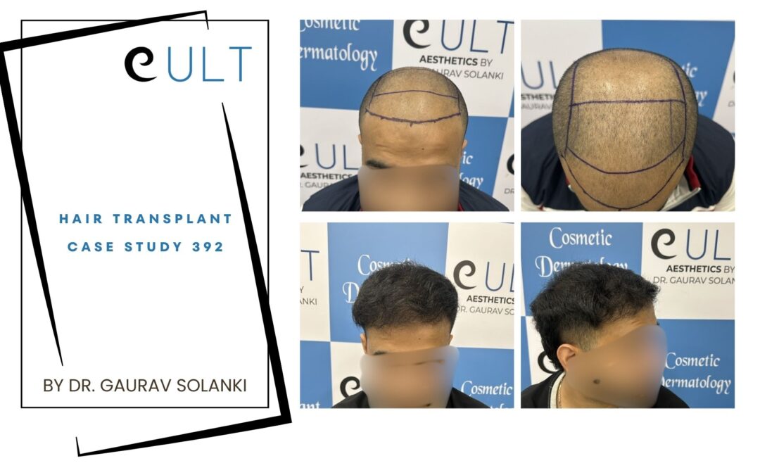 Hair Transplant Case 392