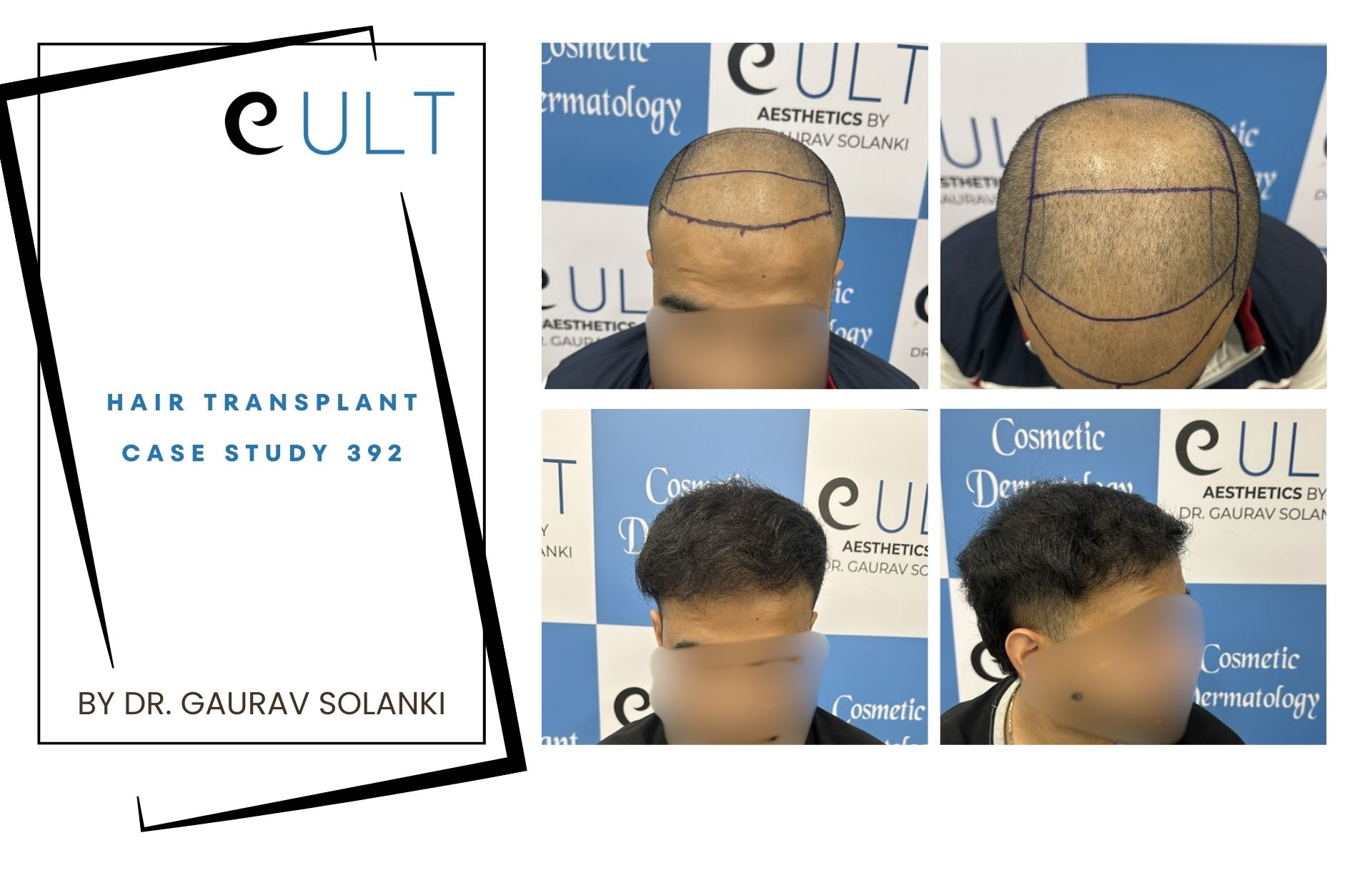 Hair Transplant case 392
