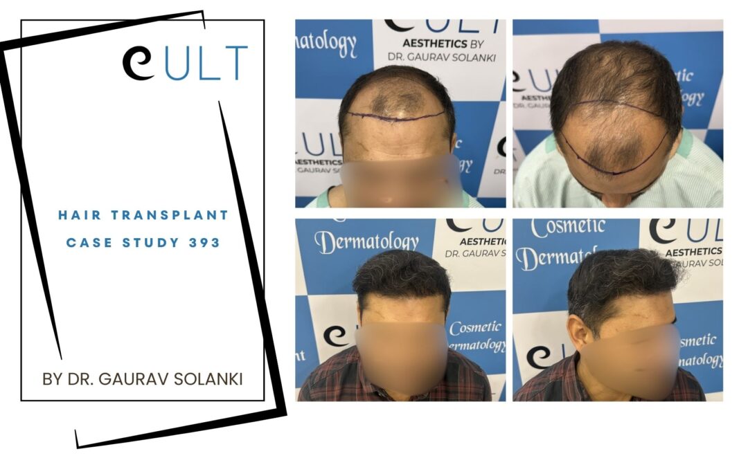 Hair Transplant Case 393