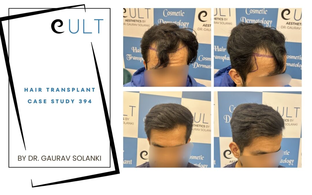 Hair Transplant Case 394