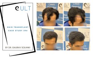 Hair Transplant case 394