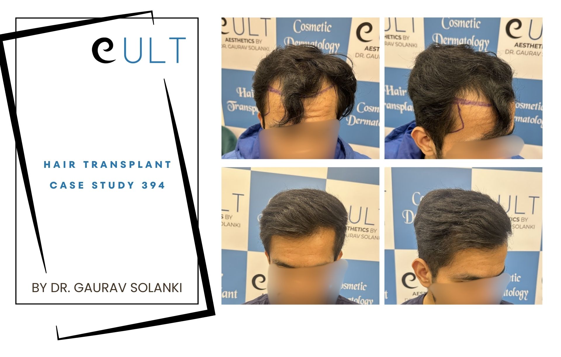 Hair Transplant case 394