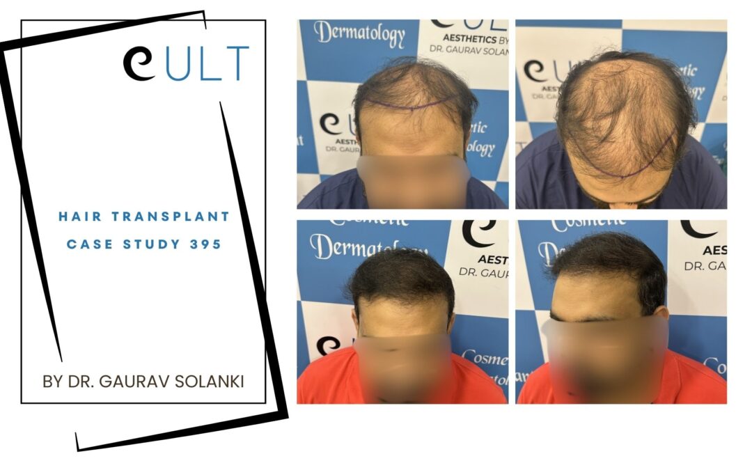 Hair Transplant Case 395
