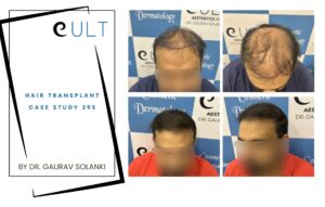 Hair Transplant case 395