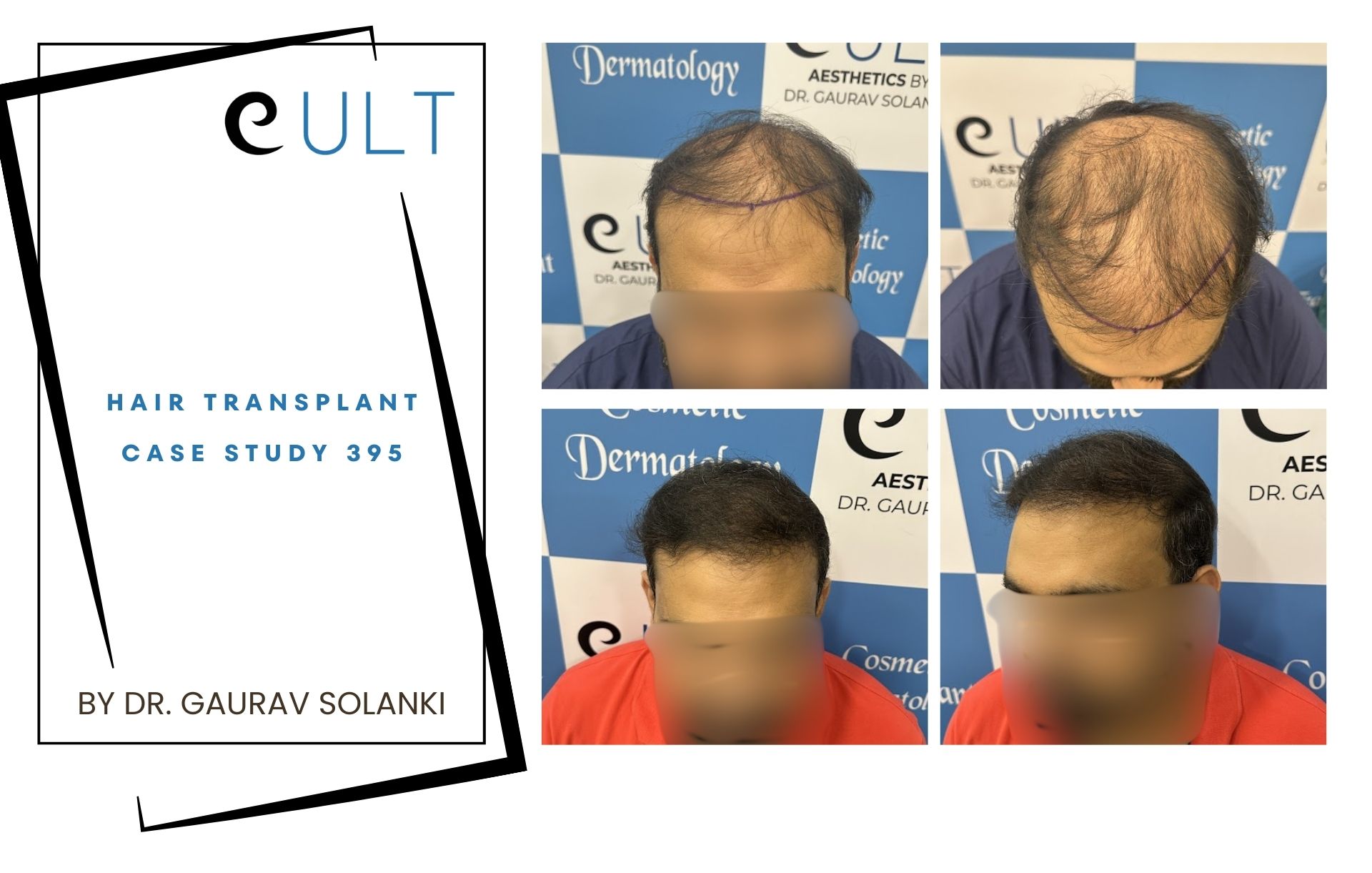 Hair Transplant case 395