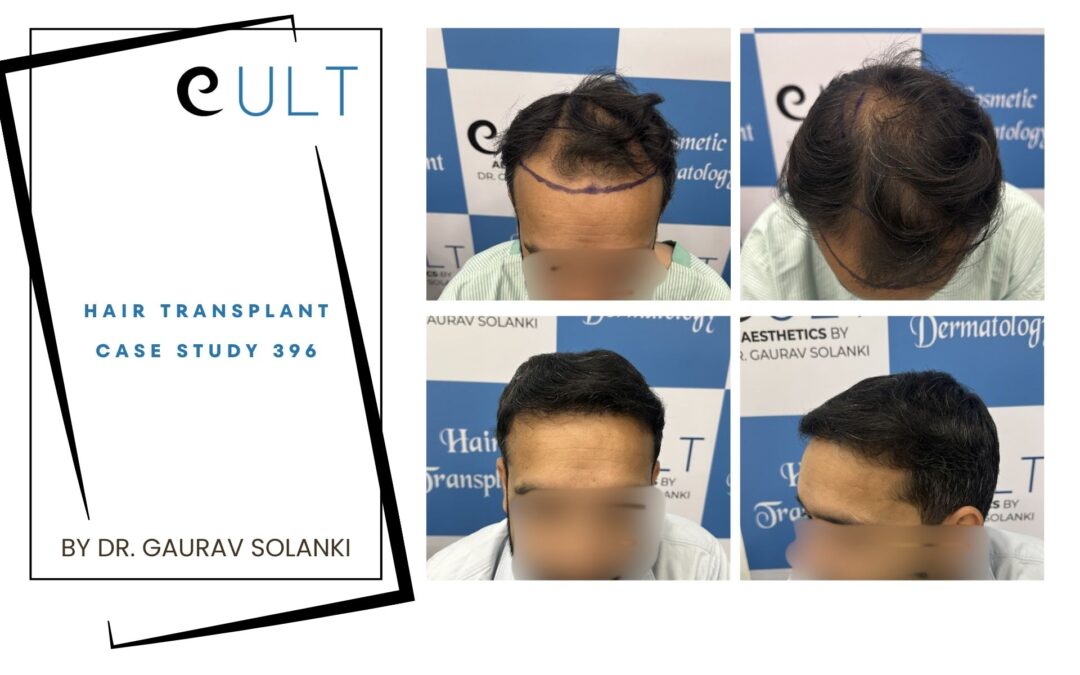 Hair Transplant Case 396