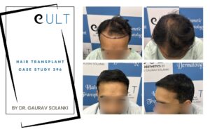 Hair Transplant case 396